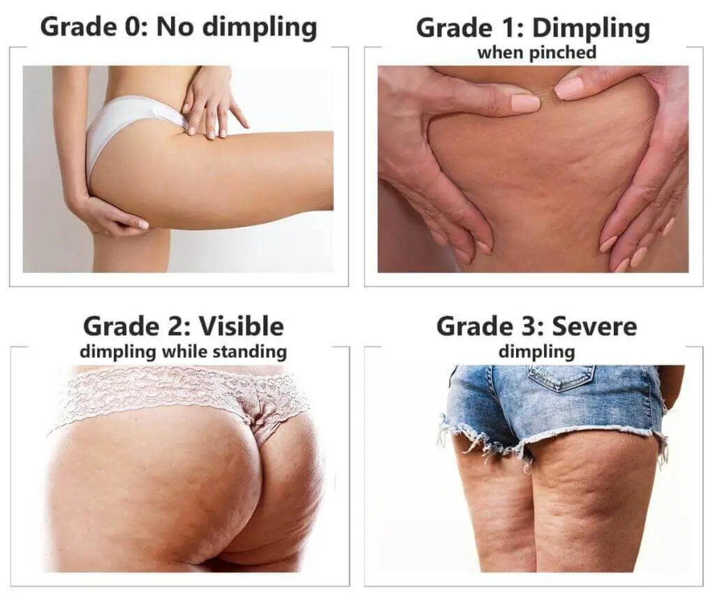 Representation of the stages of cellulite development Coombe Bissett